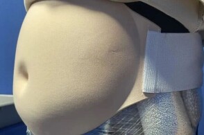 3月13日拱北海关所属横琴海关查获一起旅客绑藏白银颗粒进境案白银总...